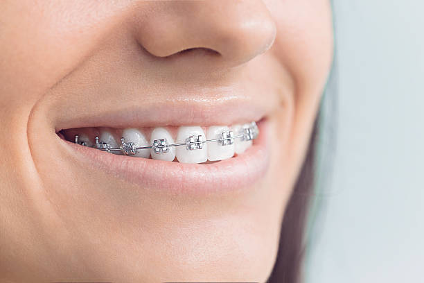 Best Teeth Whitening  in Shreveport, LA